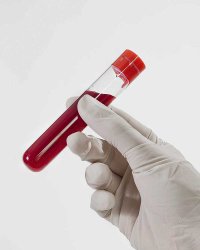 Дефицит железа: что стоит знать о анемии